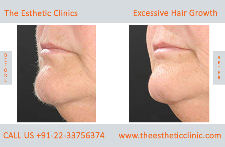 Excessive Hair Growth Removal Treatment before after photos in mumbai india (5)